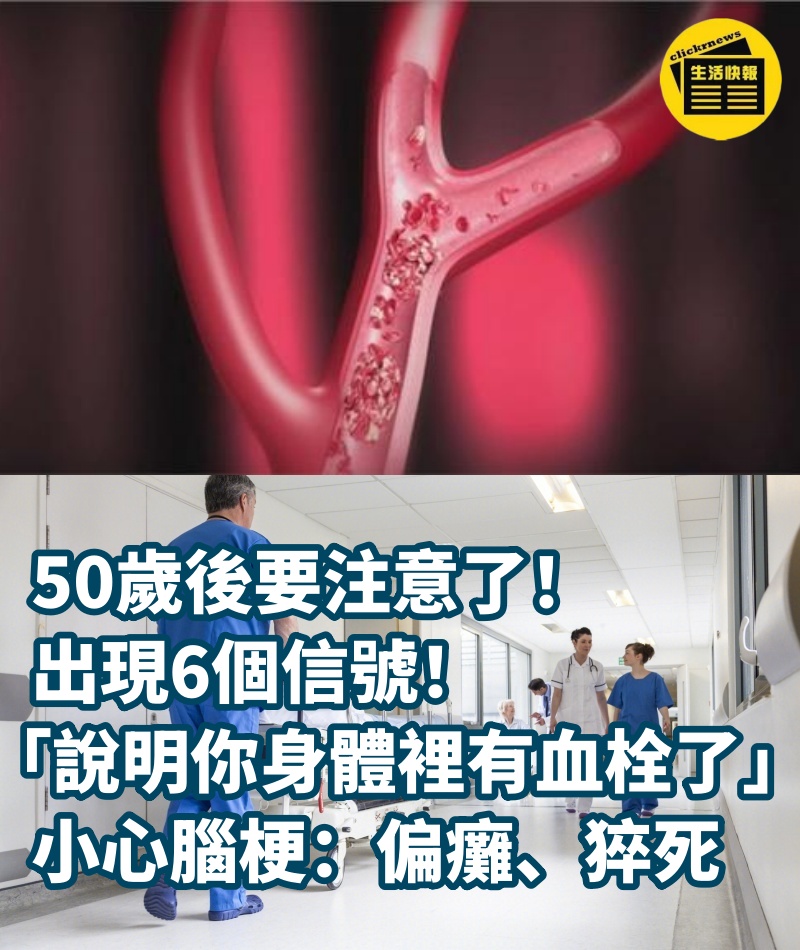 50歲後要注意了！出現6個信號「說明你身體裡有血栓了」　小心腦梗：偏癱、猝死